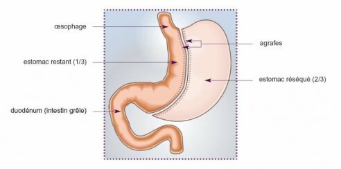 Sleeve Tunisie : prix sleeve gastrique, chirurgie obesite Sleeve Tunisie : prix sleeve gastrique, chirurgie obesite